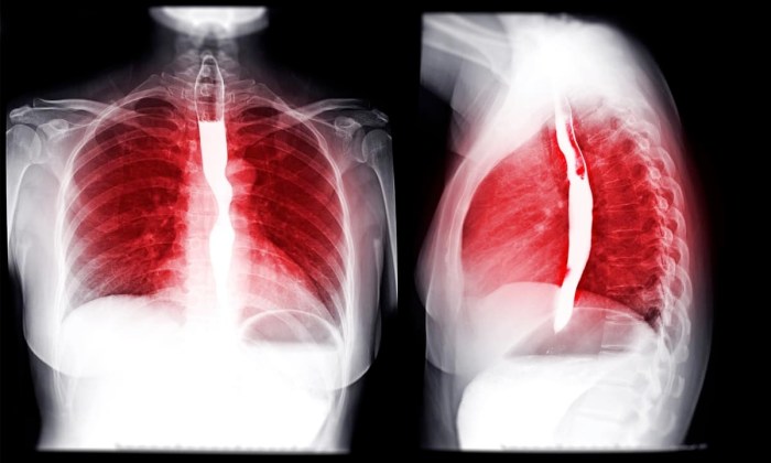 Barium swallow prep performed indications healthjade